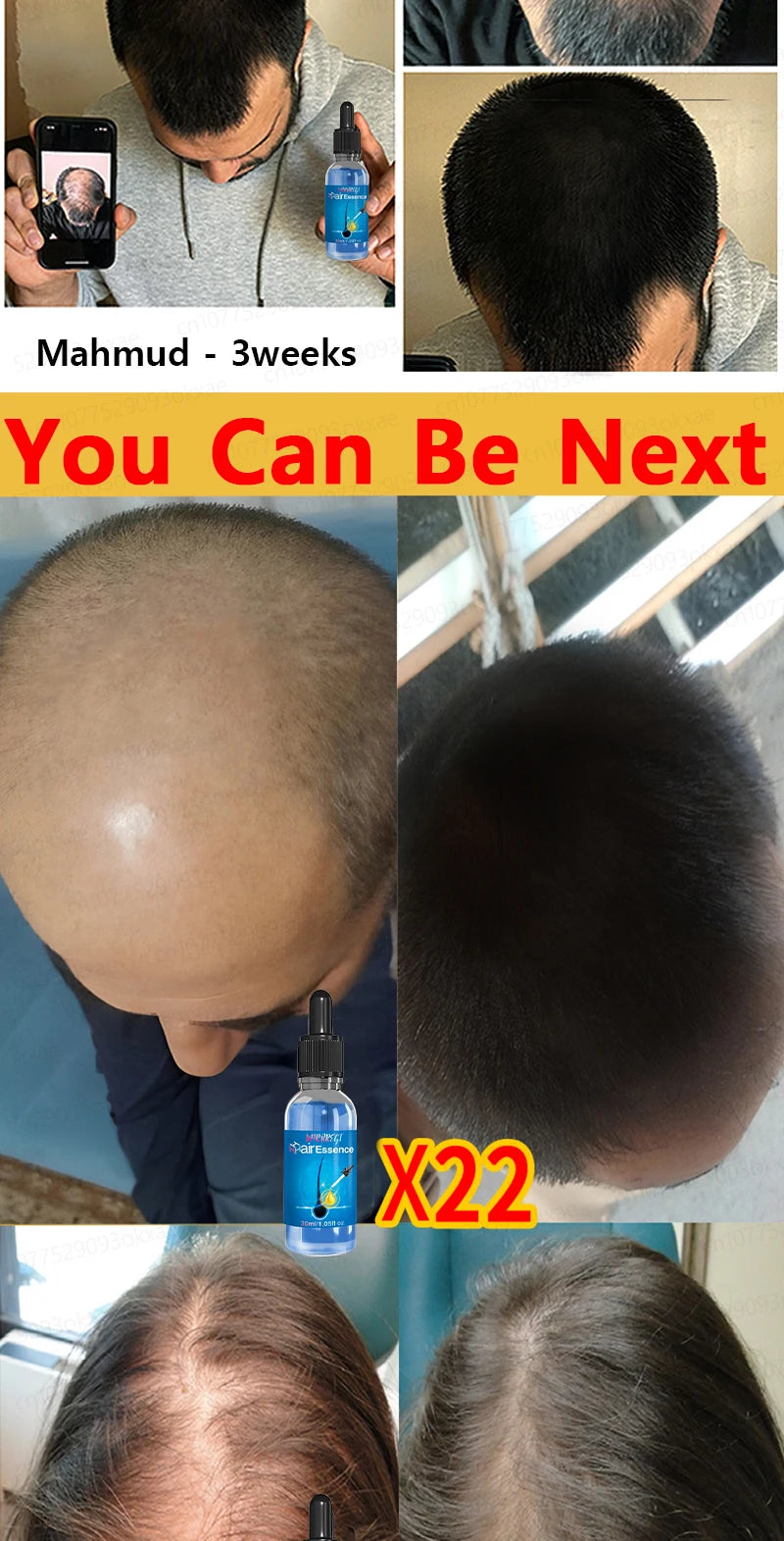 Hair growth essential oil, effectively repair baldness and hair loss, new hair growth